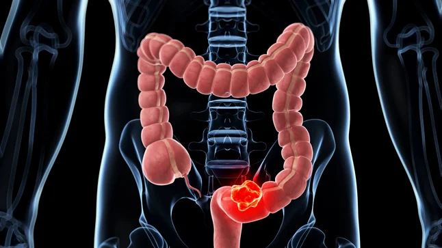 Cáncer de colon: señales de alerta