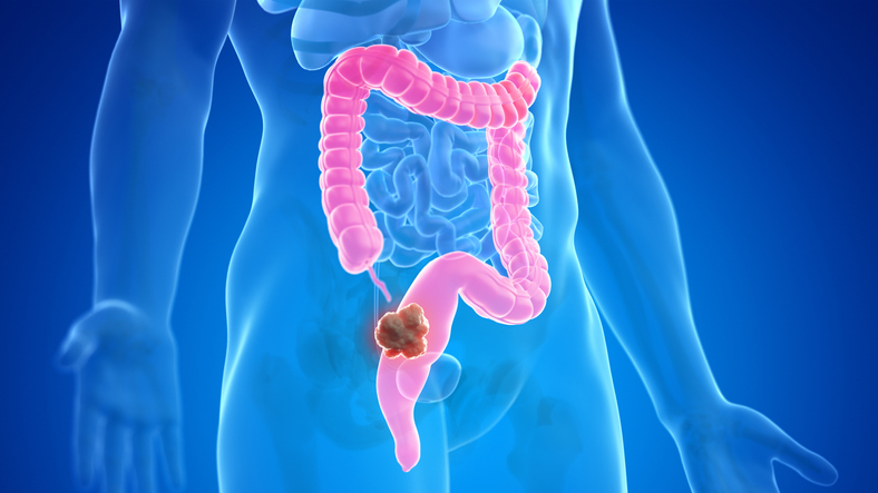 Cáncer de colon: síntomas
